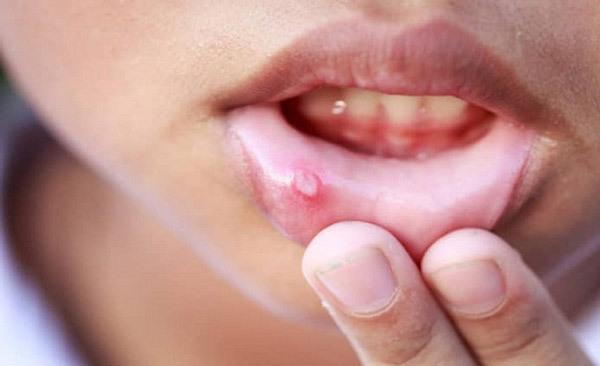 آفت دهان چیست؟ راه های درمان خانگی و دارویی